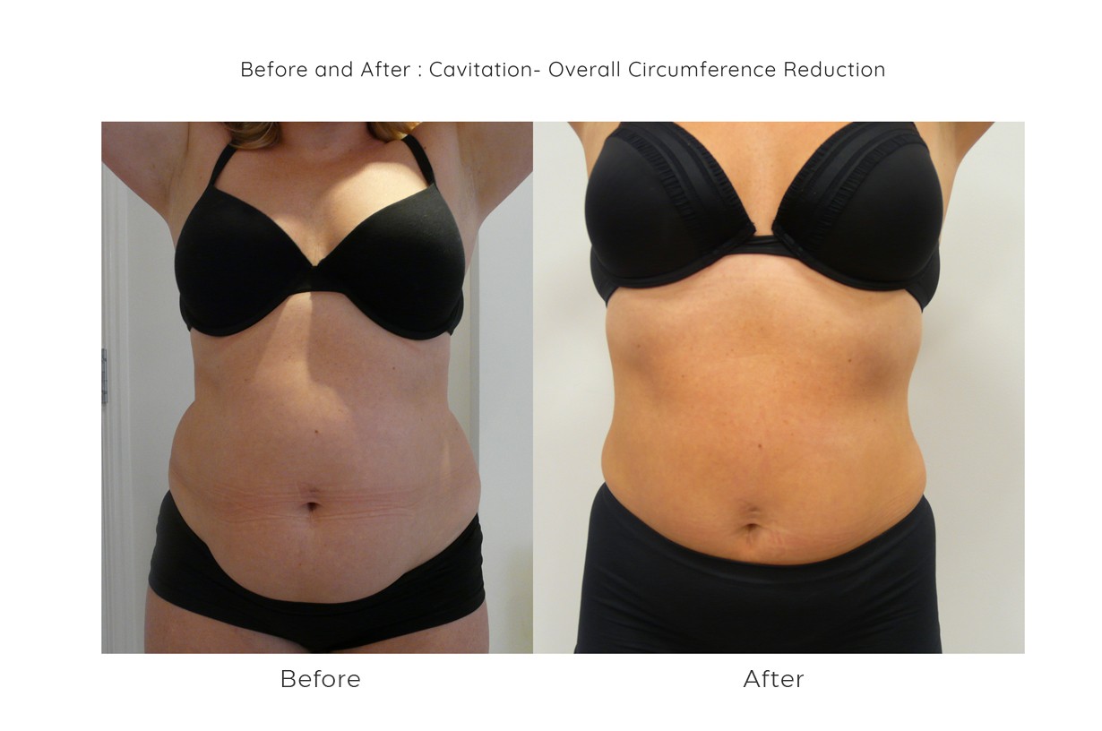 3D Cavitation Fat Removal Mansfield, Nottingham and Derby