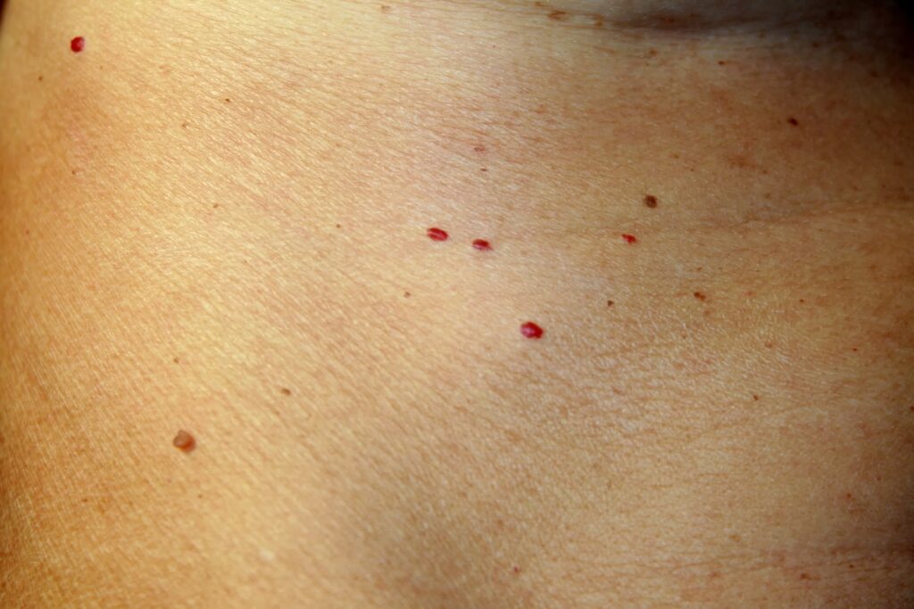Cherry Angiomas Laser Treatment