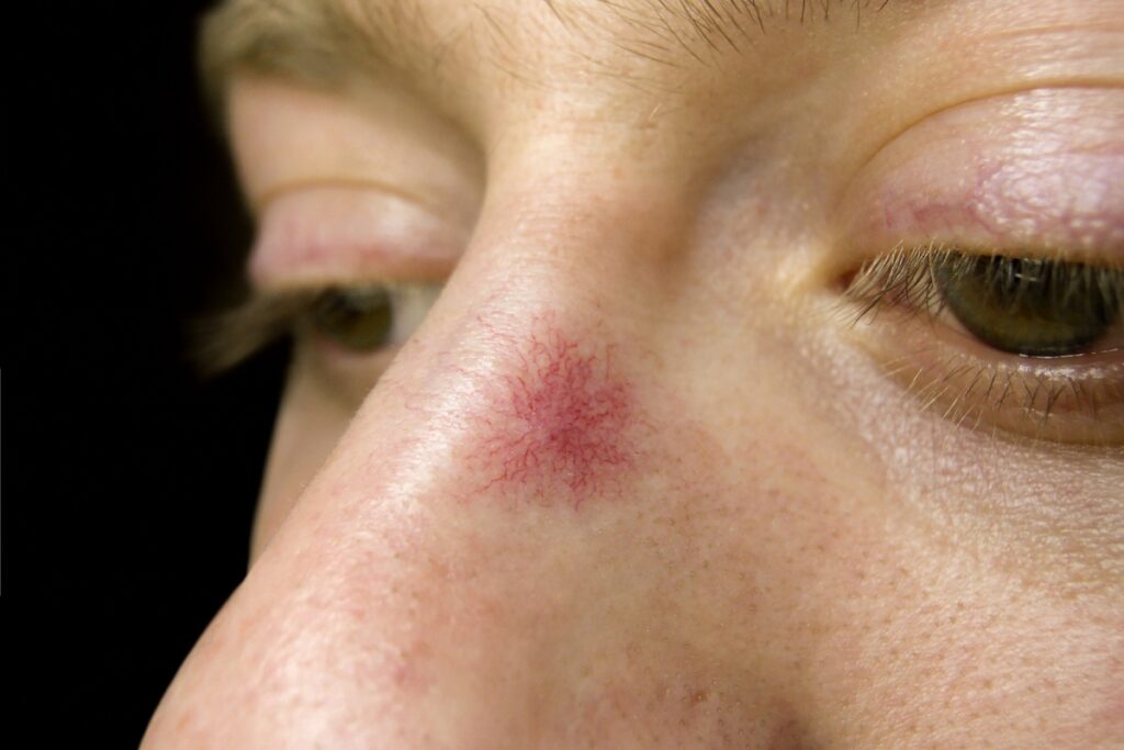 Spider Naevis Laser Treatment