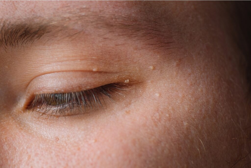 Milia and Blackhead Removal in Nottingham