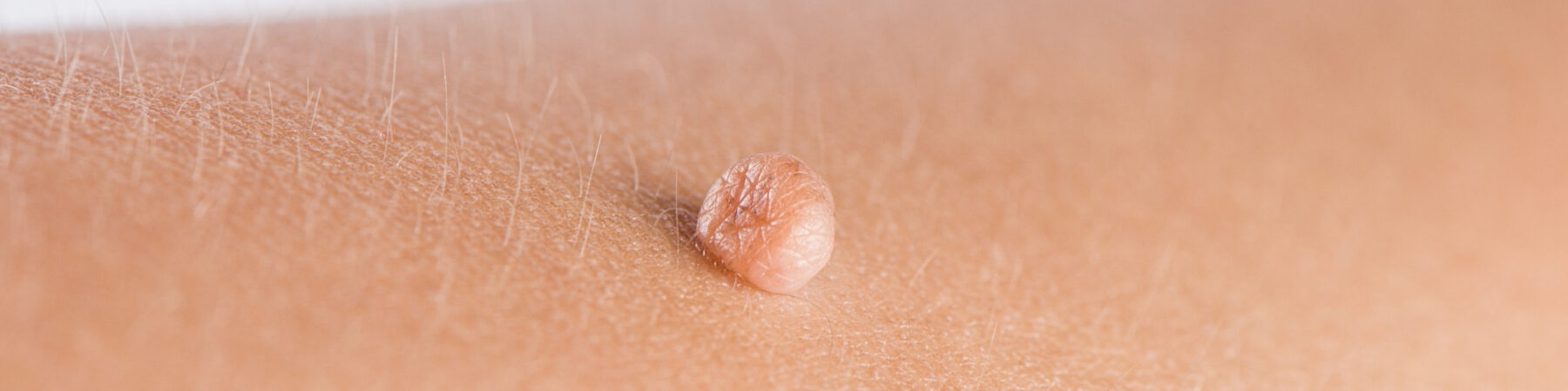 Skin Tag Removal Nottingham