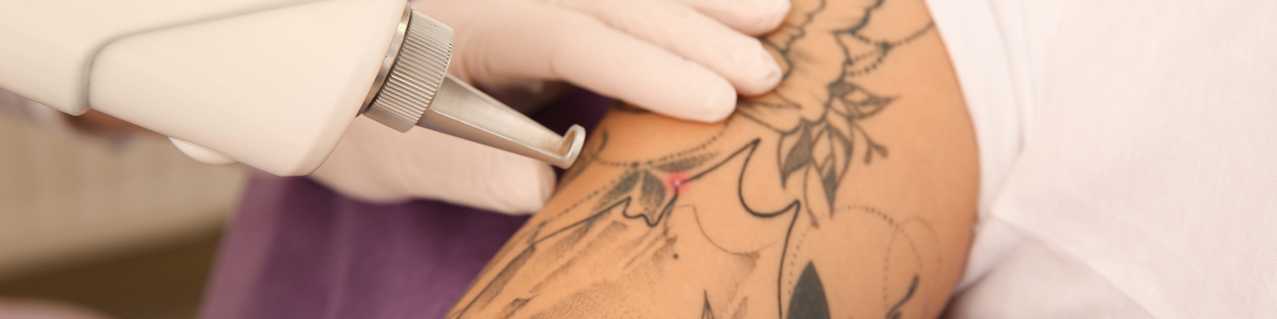 Laser Tattoo Removal