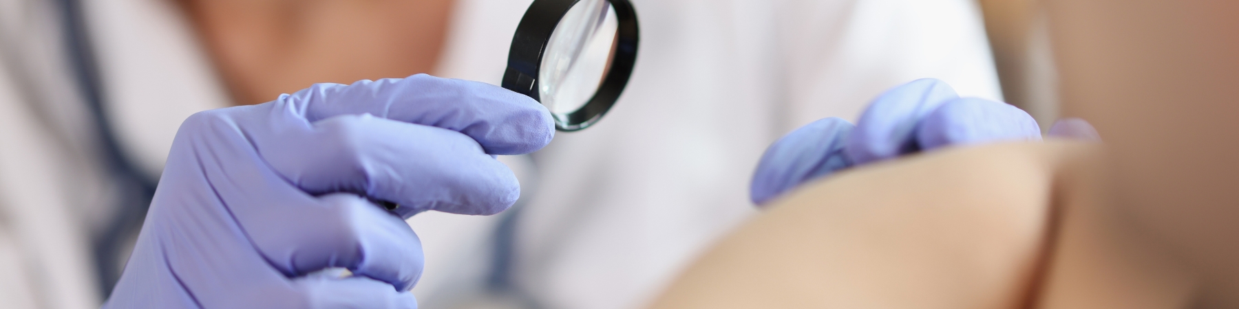Skin Tag Removal Nottingham