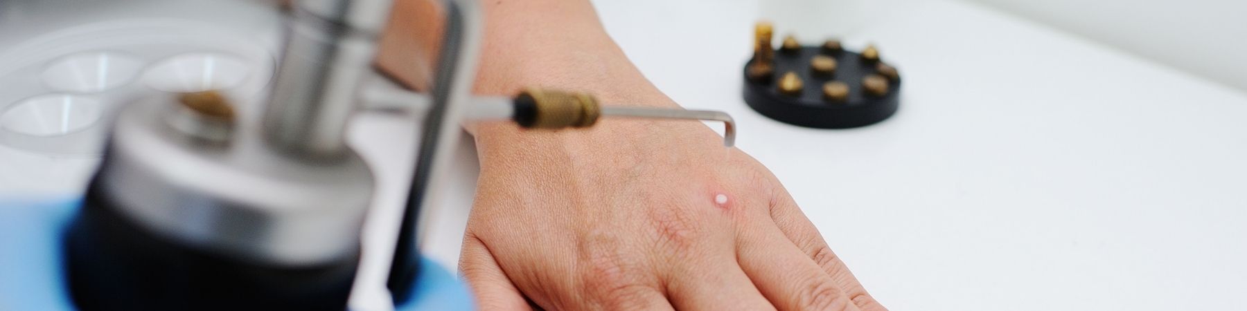 Wart Removal in Nottingham
